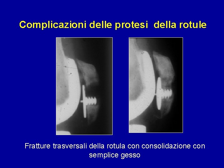 Complicazioni delle protesi della rotule Fratture trasversali della rotula consolidazione con semplice gesso 