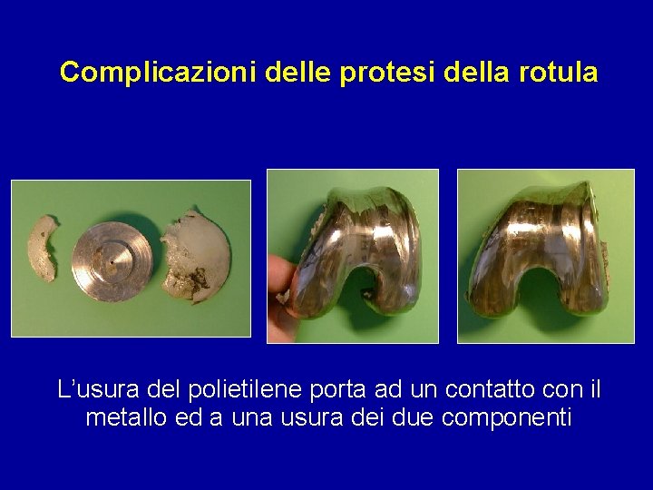 Complicazioni delle protesi della rotula L’usura del polietilene porta ad un contatto con il