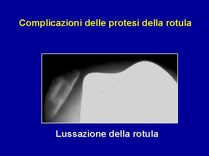 Complicazioni delle protesi della rotula Lussazione della rotula 