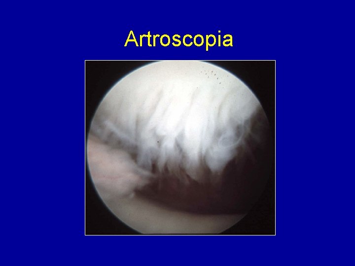 Artroscopia 