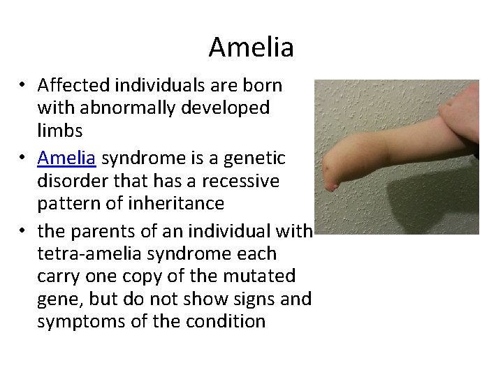 Amelia • Affected individuals are born with abnormally developed limbs • Amelia syndrome is