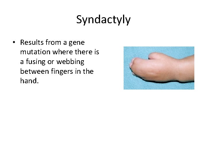 Syndactyly • Results from a gene mutation where there is a fusing or webbing