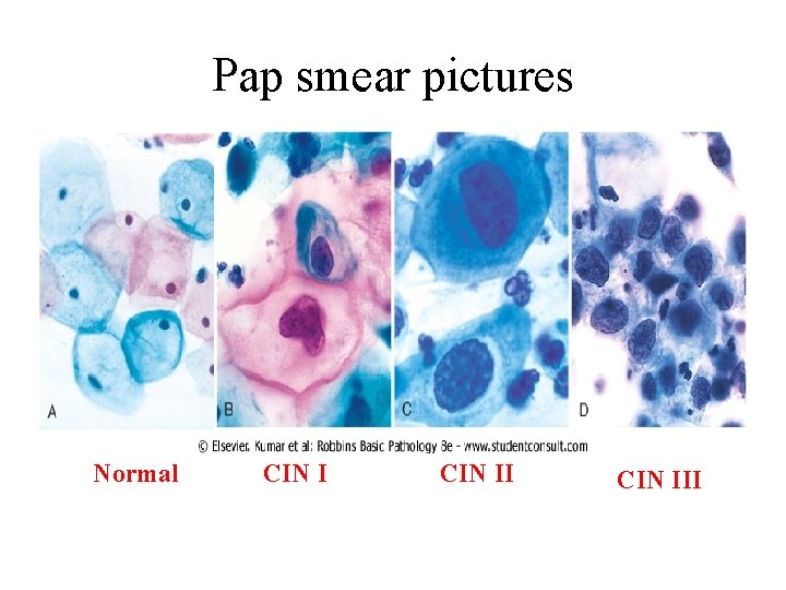 Pap smear pictures Normal CIN III 