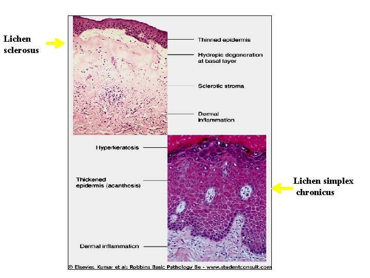 Lichen sclerosus Lichen simplex chronicus 