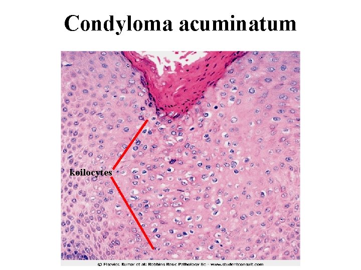 Condyloma acuminatum koilocytes 