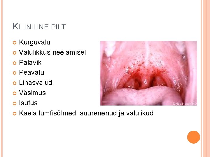 KLIINILINE PILT Kurguvalu Valulikkus neelamisel Palavik Peavalu Lihasvalud Väsimus Isutus Kaela lümfisõlmed suurenenud ja