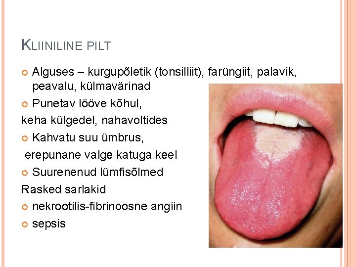 KLIINILINE PILT Alguses – kurgupõletik (tonsilliit), farüngiit, palavik, peavalu, külmavärinad Punetav lööve kõhul, keha