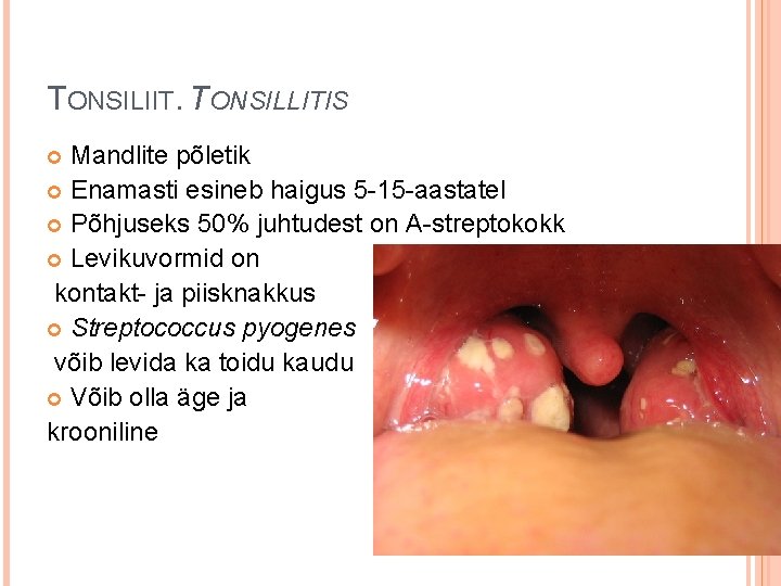 TONSILIIT. TONSILLITIS Mandlite põletik Enamasti esineb haigus 5 -15 -aastatel Põhjuseks 50% juhtudest on