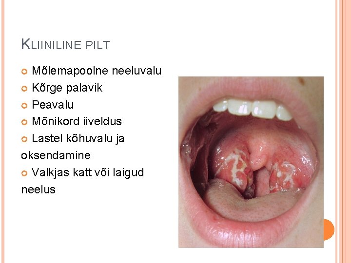 KLIINILINE PILT Mõlemapoolne neeluvalu Kõrge palavik Peavalu Mõnikord iiveldus Lastel kõhuvalu ja oksendamine Valkjas