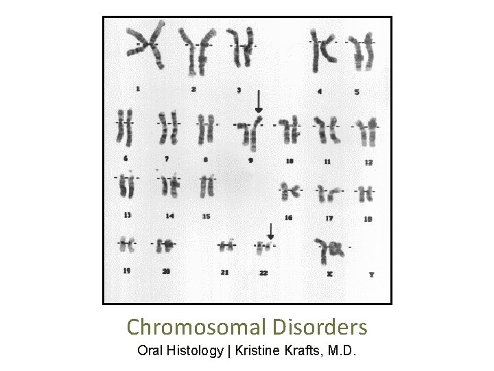 Chromosomal Disorders Oral Histology | Kristine Krafts, M. D. 