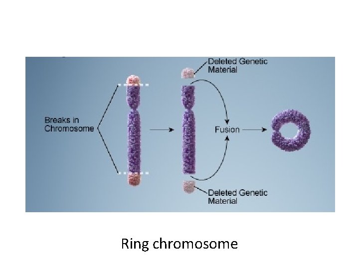 Ring chromosome 