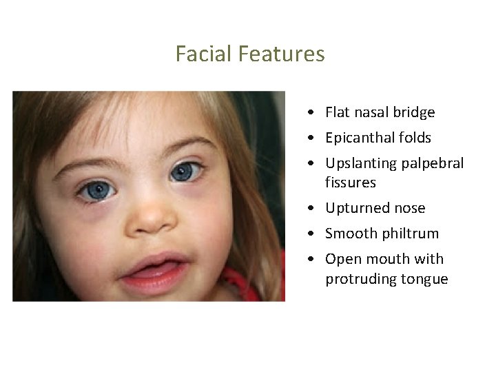 Facial Features • Flat nasal bridge • Epicanthal folds • Upslanting palpebral fissures •