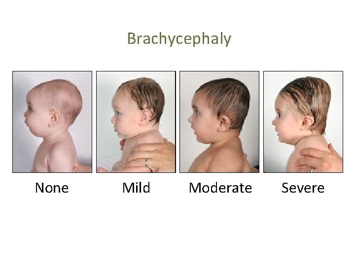 Brachycephaly None Mild Moderate Severe 