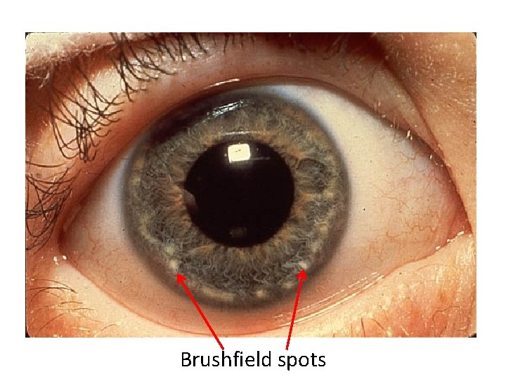 Brushfield spots 