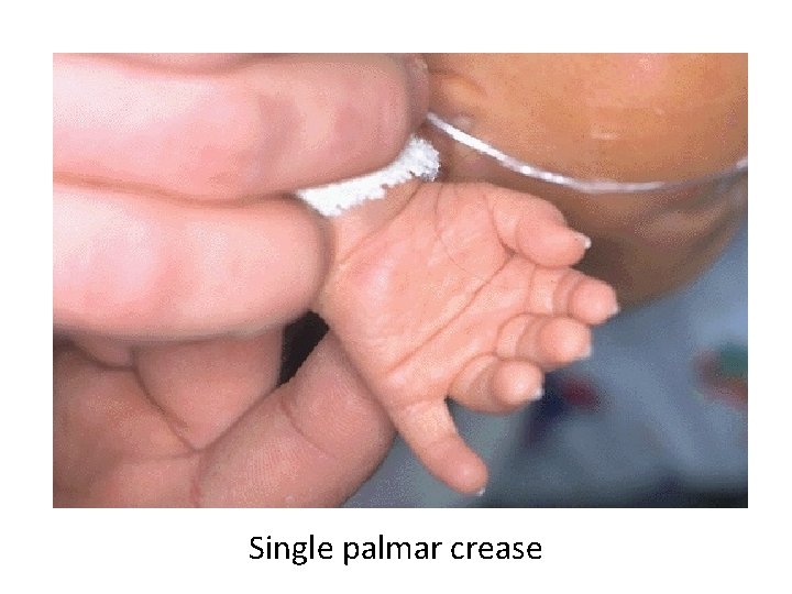 Single palmar crease 