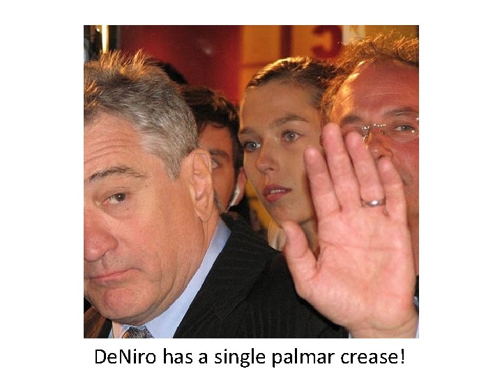 De. Niro has a single palmar crease! 