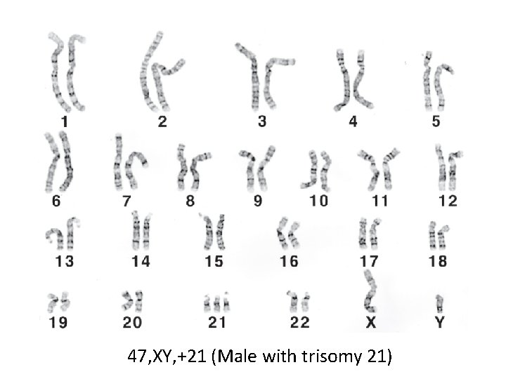 47, XY, +21 (Male with trisomy 21) 