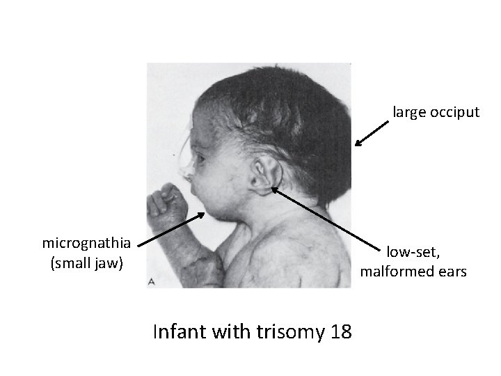 large occiput micrognathia (small jaw) low-set, malformed ears Infant with trisomy 18 