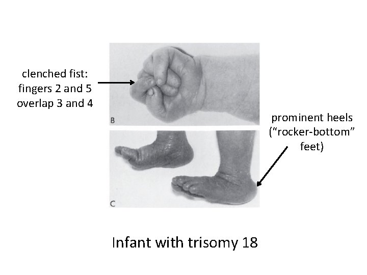 clenched fist: fingers 2 and 5 overlap 3 and 4 prominent heels (“rocker-bottom” feet)