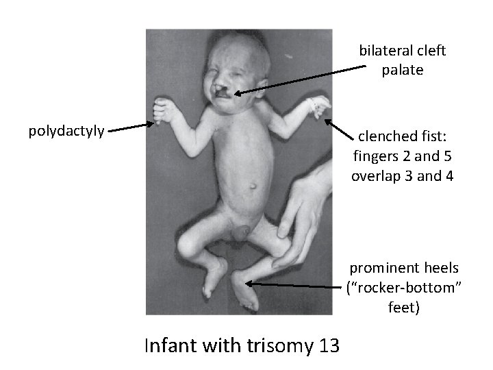 bilateral cleft palate polydactyly clenched fist: fingers 2 and 5 overlap 3 and 4