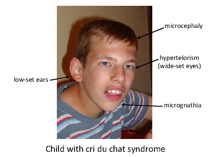 microcephaly hypertelorism (wide-set eyes) low-set ears micrognathia Child with cri du chat syndrome 