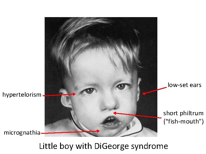 low-set ears hypertelorism short philtrum (“fish-mouth”) micrognathia Little boy with Di. George syndrome 