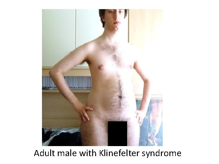 Adult male with Klinefelter syndrome 