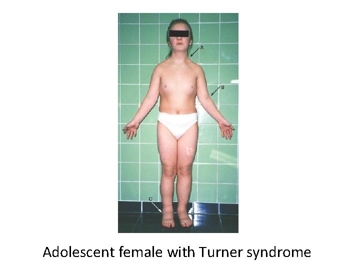 Adolescent female with Turner syndrome 