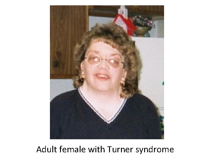 Adult female with Turner syndrome 
