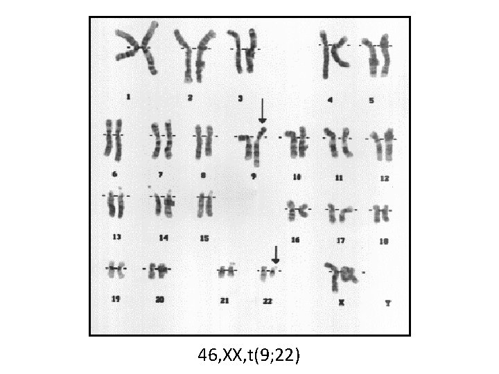 46, XX, t(9; 22) 