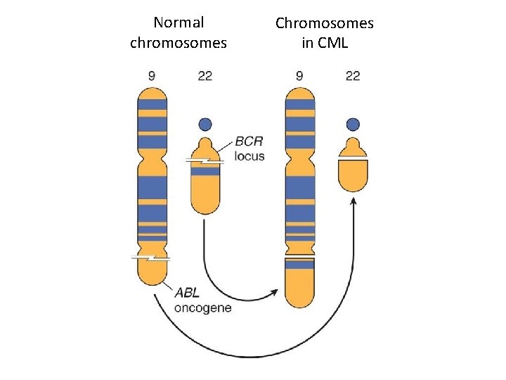 Normal chromosomes Chromosomes in CML 