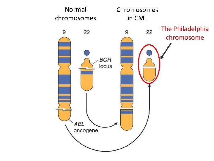 Normal chromosomes Chromosomes in CML The Philadelphia chromosome 