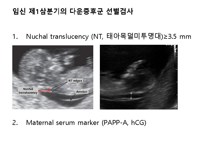 임신 제 1삼분기의 다운증후군 선별검사 1. Nuchal translucency (NT, 태아목덜미투명대)≥ 3. 5 mm 2.