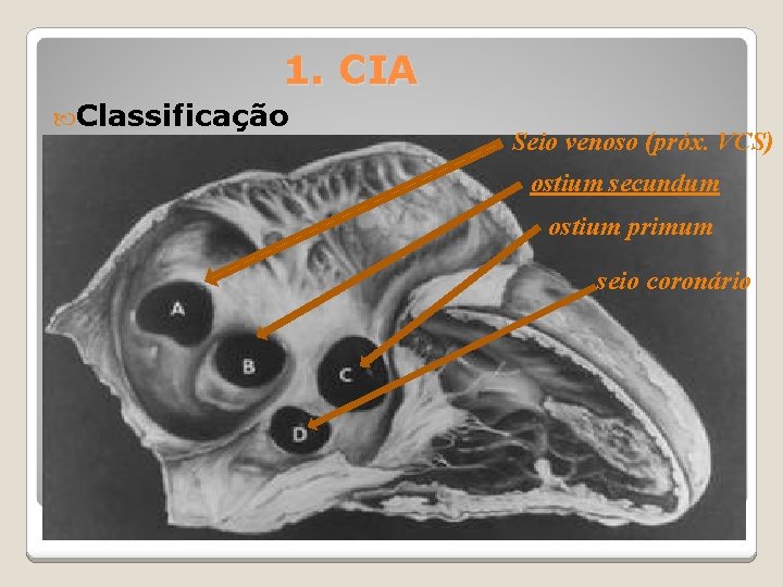 1. CIA Classificação Seio venoso (próx. VCS) ostium secundum ostium primum seio coronário 