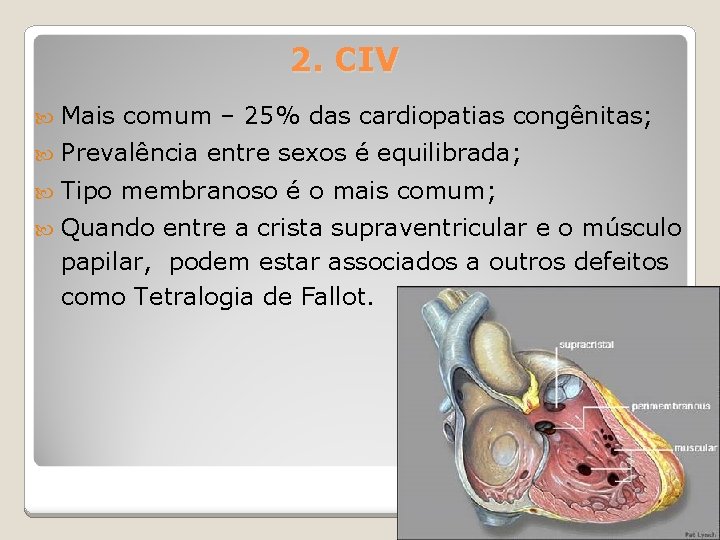 2. CIV Mais comum – 25% das cardiopatias congênitas; Prevalência entre sexos é equilibrada;