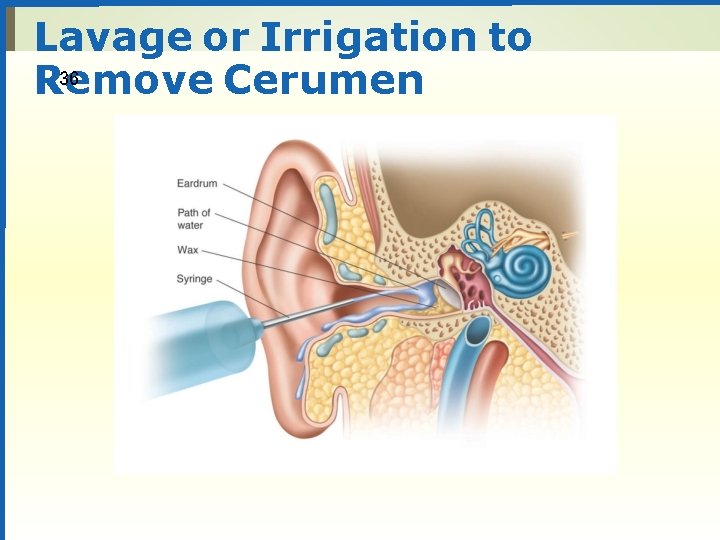 Lavage or Irrigation to 36 Remove Cerumen 