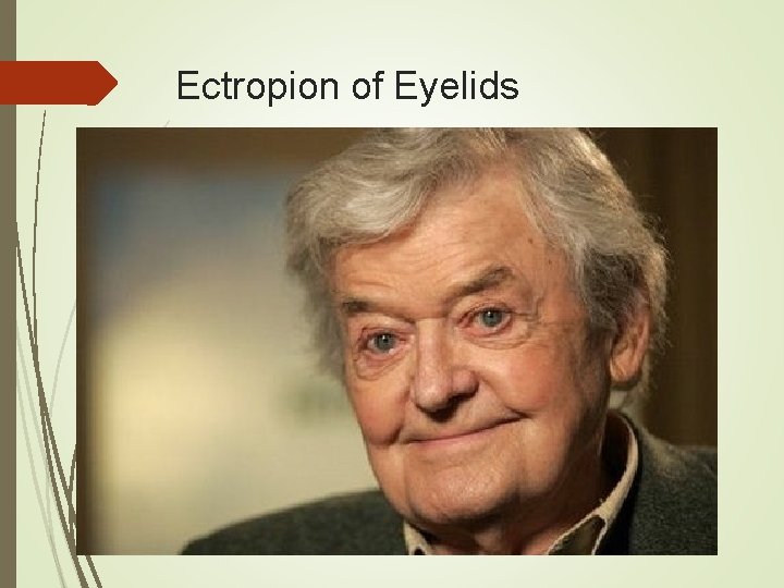 Ectropion of Eyelids 