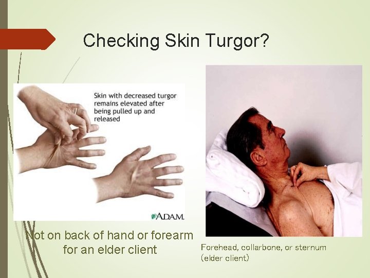 Checking Skin Turgor? Not on back of hand or forearm for an elder client