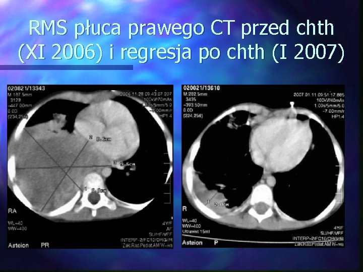 RMS płuca prawego CT przed chth (XI 2006) i regresja po chth (I 2007)