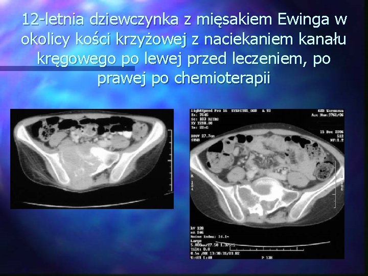 12 -letnia dziewczynka z mięsakiem Ewinga w okolicy kości krzyżowej z naciekaniem kanału kręgowego