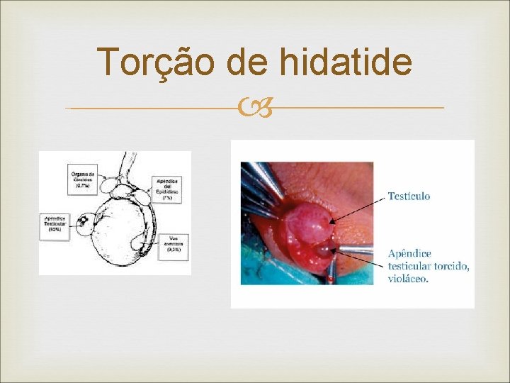 Torção de hidatide 