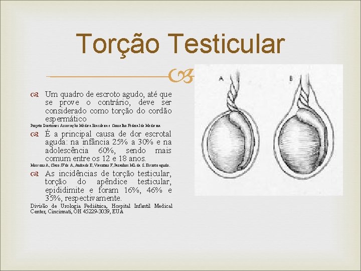 Torção Testicular Um quadro de escroto agudo, até que se prove o contrário, deve