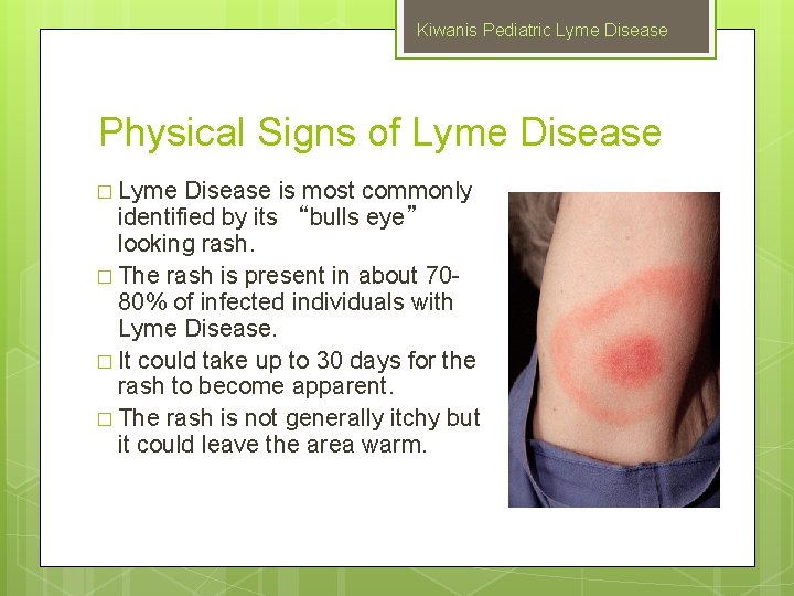 Kiwanis Pediatric Lyme Disease Physical Signs of Lyme Disease � Lyme Disease is most