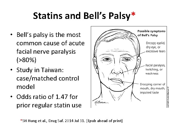 Statins and Bell’s Palsy* • Bell’s palsy is the most common cause of acute