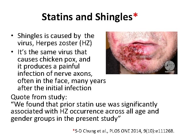 Statins and Shingles* • Shingles is caused by the virus, Herpes zoster (HZ) •