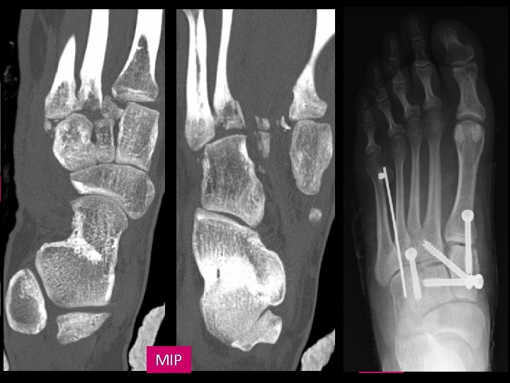 CORONAL MIP CORONAL A LA ART. CUNEOMETATARSIAN VR A 