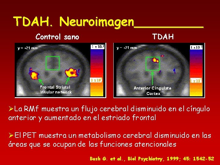 TDAH. Neuroimagen_____ Control sano TDAH ØLa RMf muestra un flujo cerebral disminuido en el