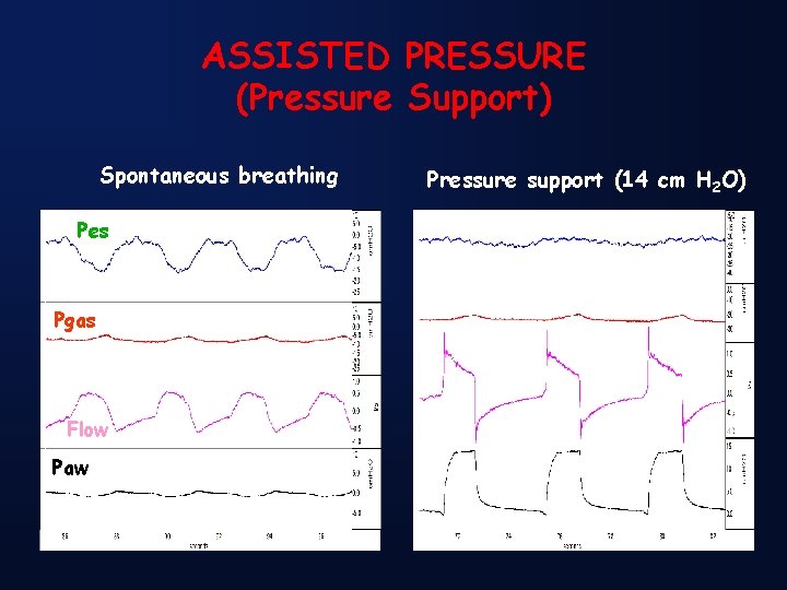 ASSISTED PRESSURE (Pressure Support) Spontaneous breathing Pes Pgas Flow Paw Pressure support (14 cm