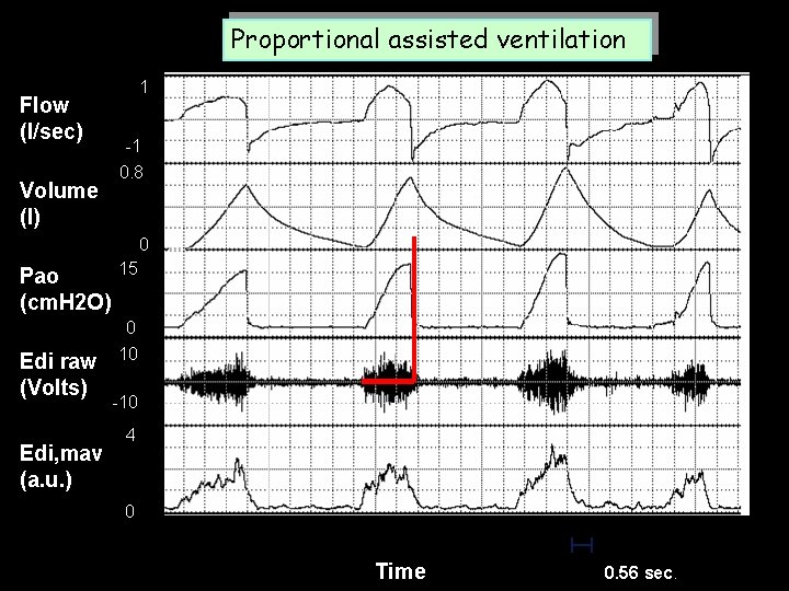 Proportional assisted ventilation Flow (l/sec) Volume (l) 1 -1 0. 8 0 Pao (cm.