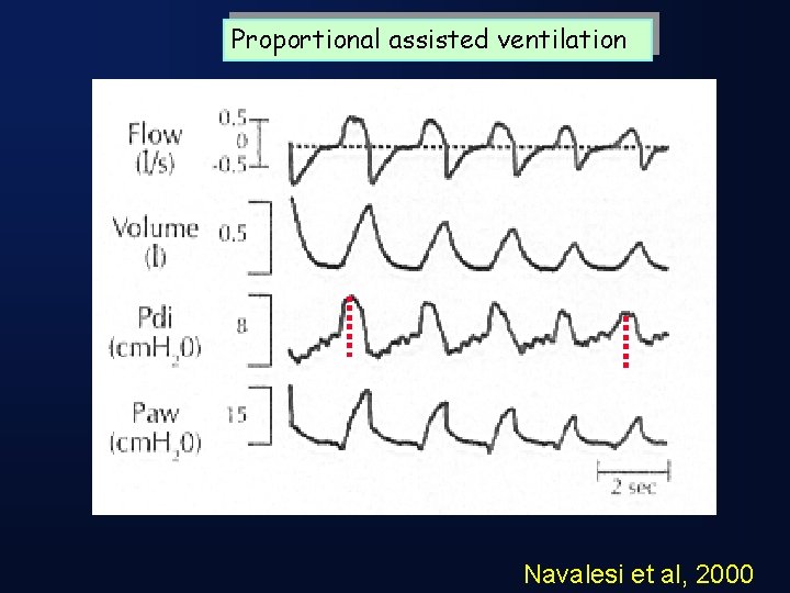 Proportional assisted ventilation Navalesi et al, 2000 